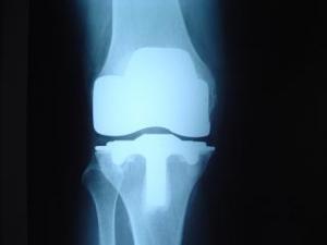 Prótesis de rodilla / cadera - Fisioterapia Barcelona